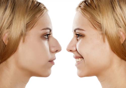 Rhinoplasty Cost in Hyderabad – Find the Best Surgeons, Reviews and Book Appointment
