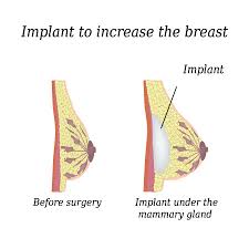 Breast Augmentation Cost in Hyderabad – Find the Best Surgeons, Reviews and Book Appointment
