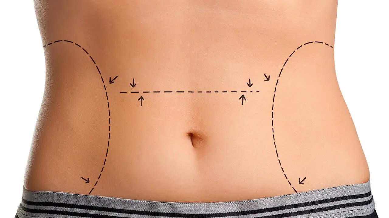 Tummy Tuck Cost in Chennai- Find the Best Surgeons, Reviews and Book Appointment