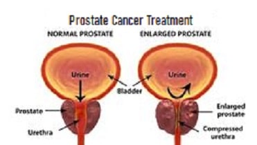 Prostate Cancer Treatment Cost in Bangalore - Find the Best Surgeon ...