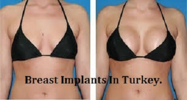Breast Implants in Turkey