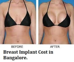 Breast Implant Cost in Bangalore Find Reviews and Book