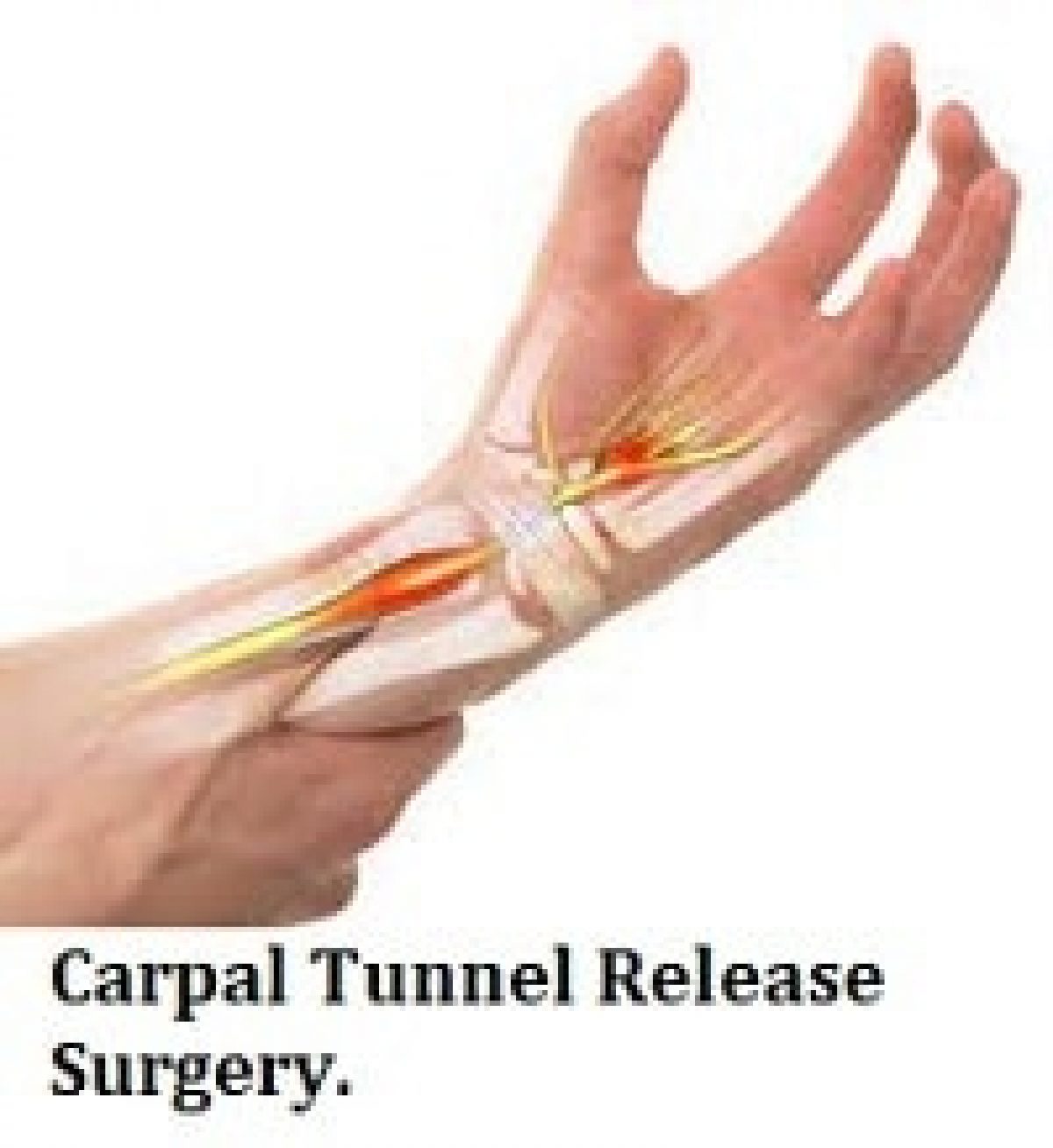 Carpal Tunnel Release Surgery Cost In India Find Reviews And Book Appointment