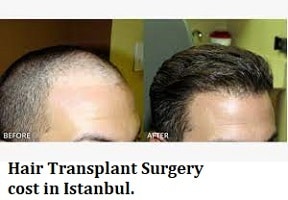 Hair Transplant Surgery cost in Istanbul - Find the best surgeon and  reviews - Expert Chikitsa