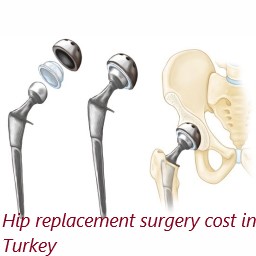 Hip Replacement Surgery In Turkey: Compare Cost, Find Best Surgeon and ...