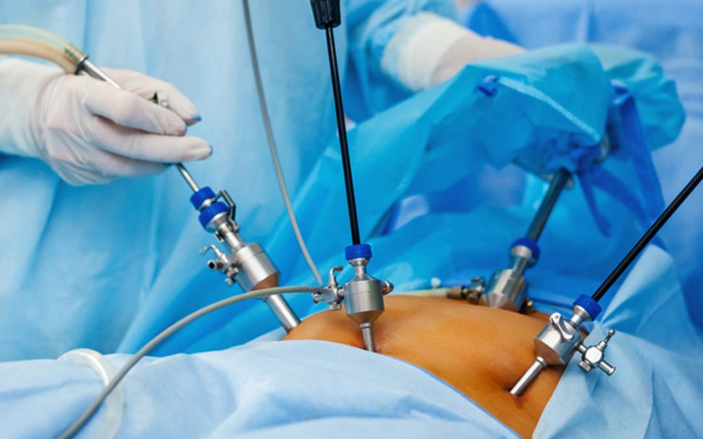 Laparoscopic Myomectomy In Hyderabad Cost And Book Appointment Expert Chikitsa 