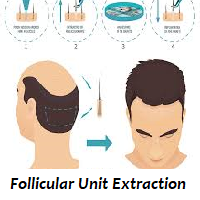 Follicular Unit Extraction