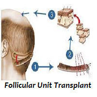 Follicular Unit Transplant
