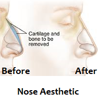 Rhinoplasty (Nose Aesthetic)