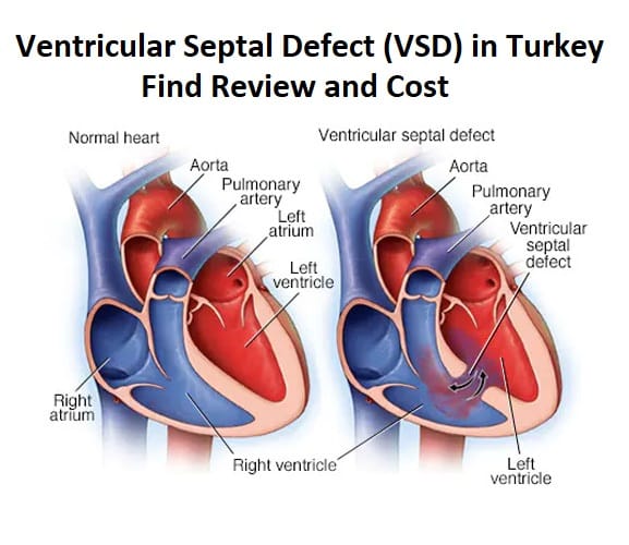 Ventricular Septal Defect (VSD) in Turkey – Find Review and Cost ...