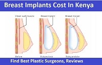 Breast Implants Cost In Kenya 2023 Find Best Plastic Surgeons